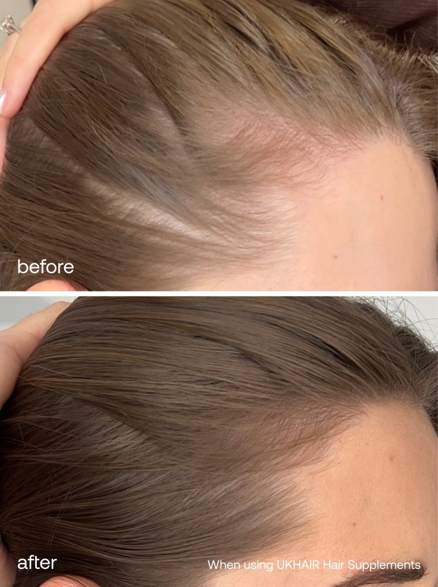 Hair Growth Serum + Advanced Hair Supplements - UKLASH