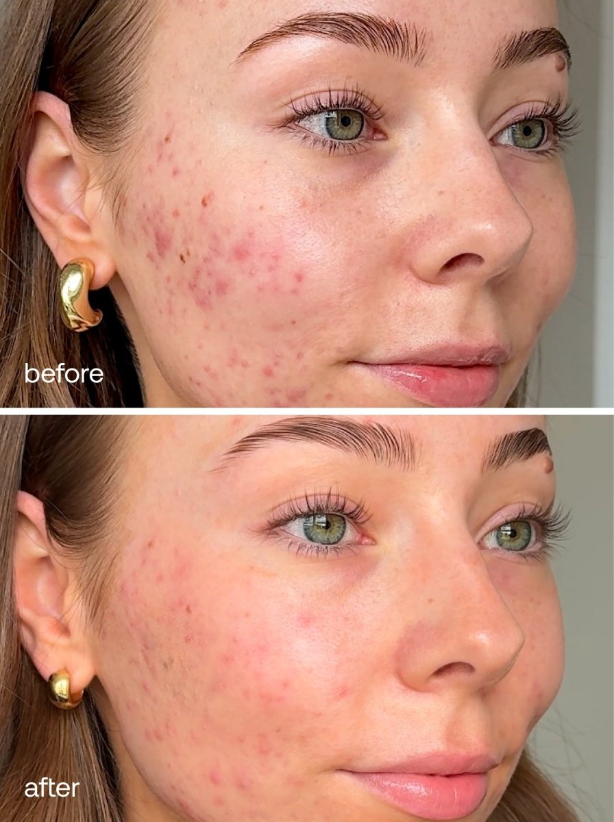 LED Dual Light Pro-Therapy Face Mask - UKLASH